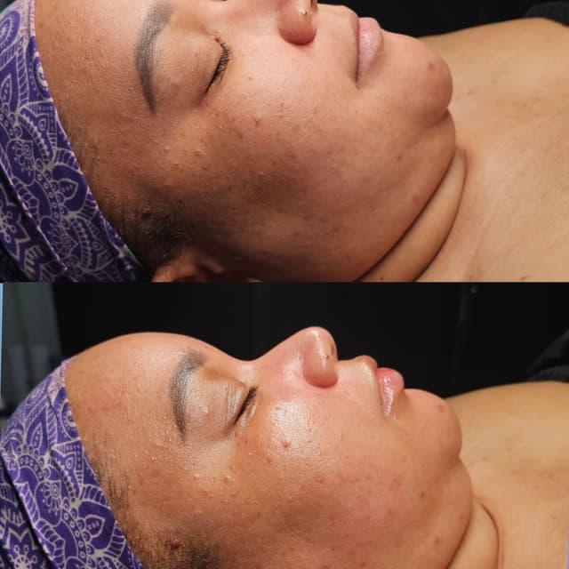 The Acne Facial Series at Aligned Beauty & Wellness in Davenport, IA